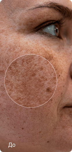 До лечения — пигментация кожи