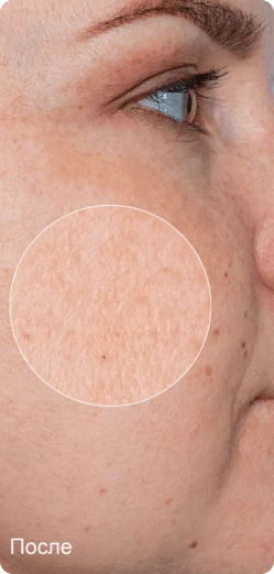 После лечения — выравнивание тона кожи